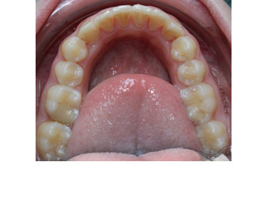 verdrongen tanden na behandeling met clearbraces