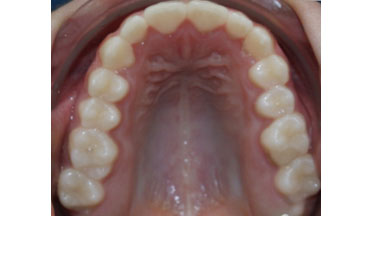 verdrongen tanden na behandeling met ClearBraces