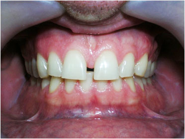 Diastema-voor